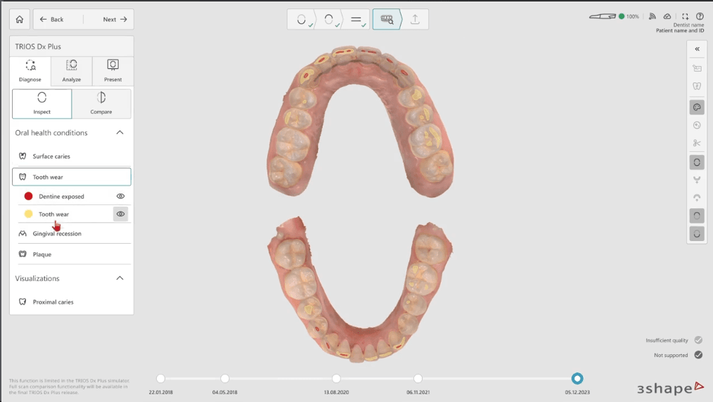 3shape TRIOS 6 - soins dentaire carie