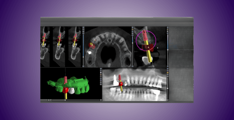 Blue Sky Plan - Conception de Guides Chirurgicaux Dentaires